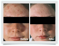 Acne Treatment - Pure Skin