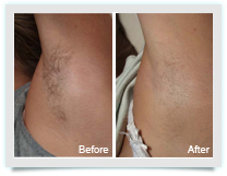Hair Removal - Pure Skin